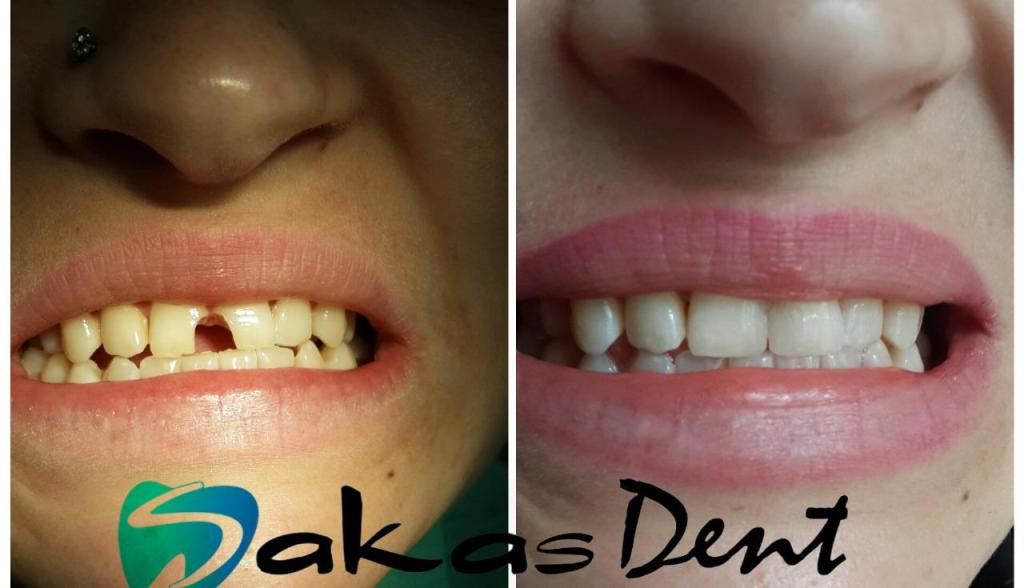 Sakas dent סכס דנט Sakas dent סכס דנט