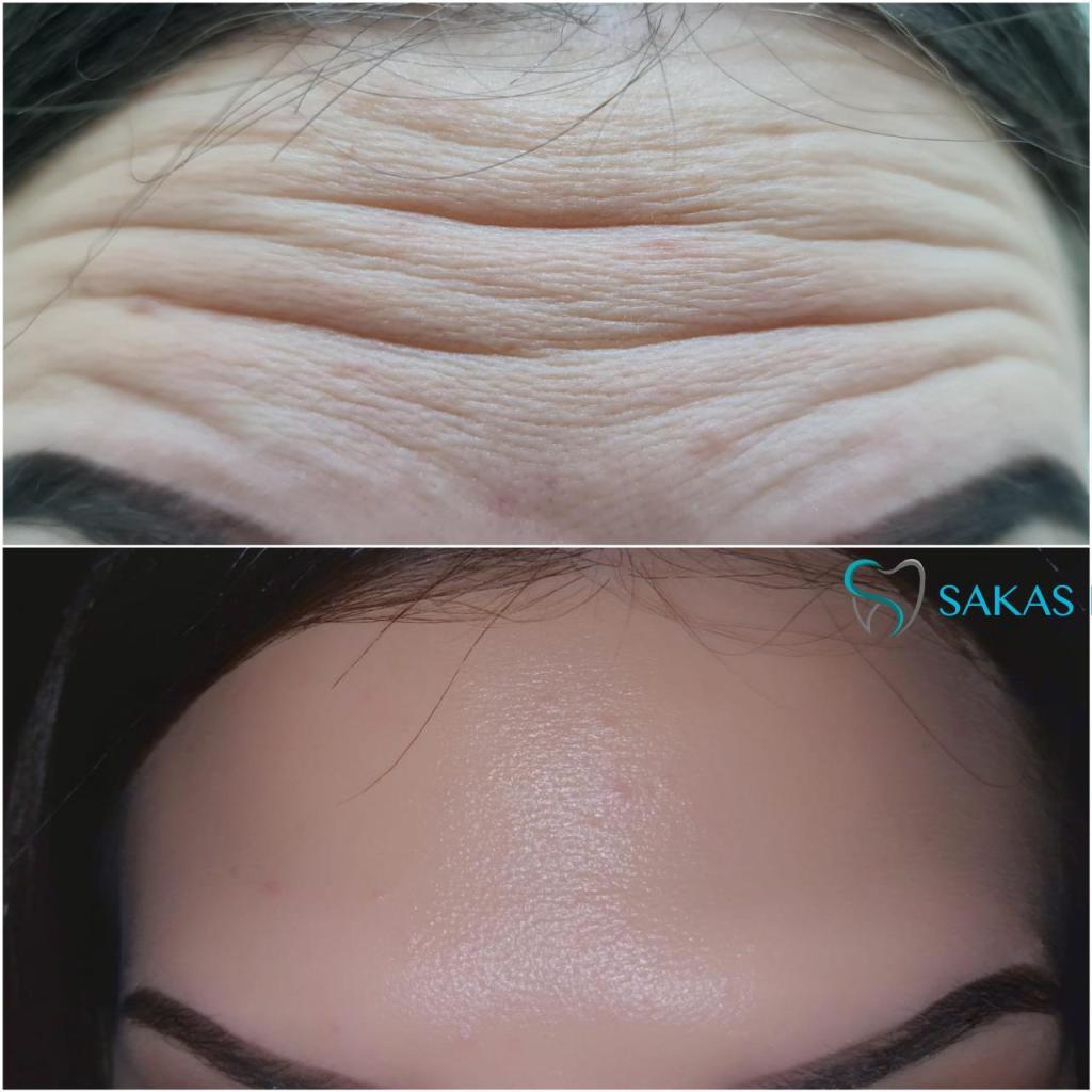 Sakas dent סכס דנט Sakas dent סכס דנט