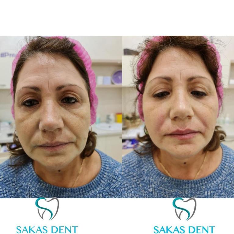 Sakas dent סכס דנט Sakas dent סכס דנט