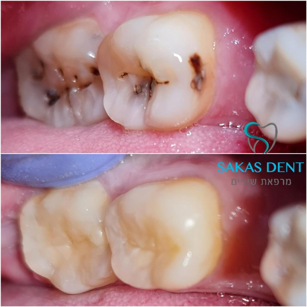 Sakas dent סכס דנט Sakas dent סכס דנט