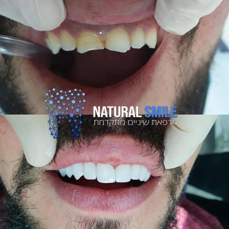 נטורל סמייל נטורל סמייל