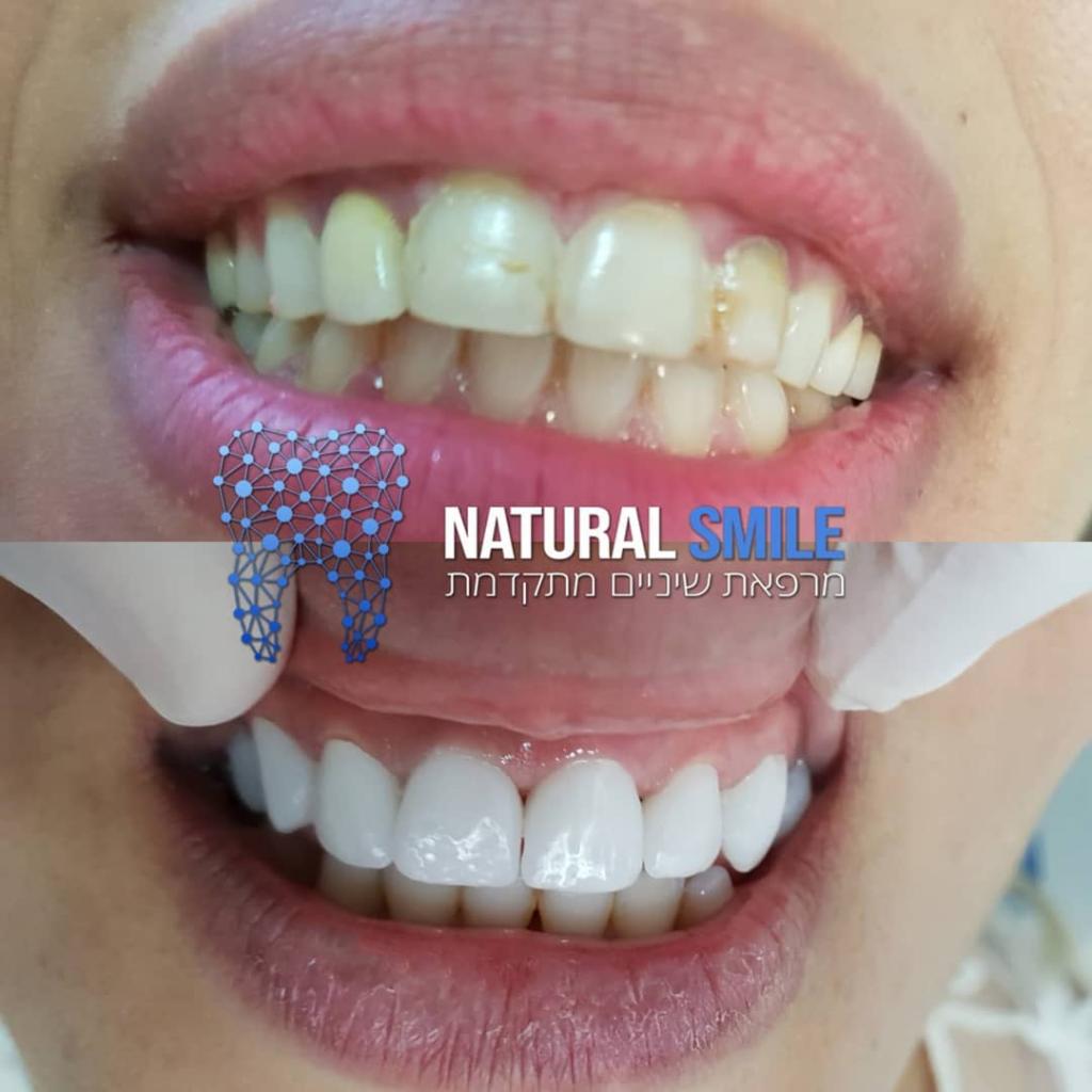 נטורל סמייל נטורל סמייל