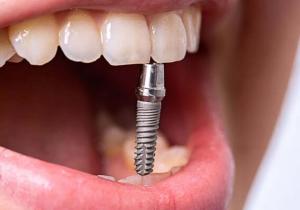 דניאל דנט המרכז להשתלות שיניים ואסתטיקה מתקדמת