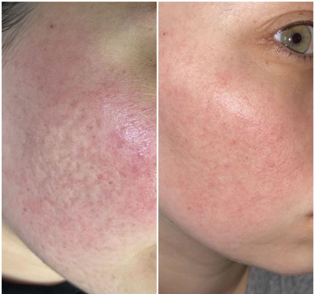 Meshi skin Meshi skin