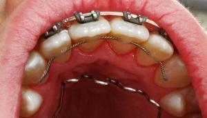 A.B Dent