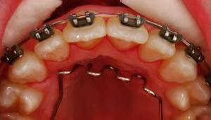 A.B Dent