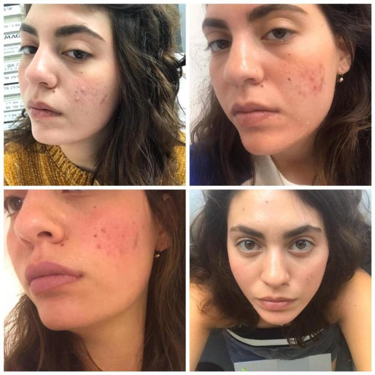 סנטר לייזר סנטר לייזר