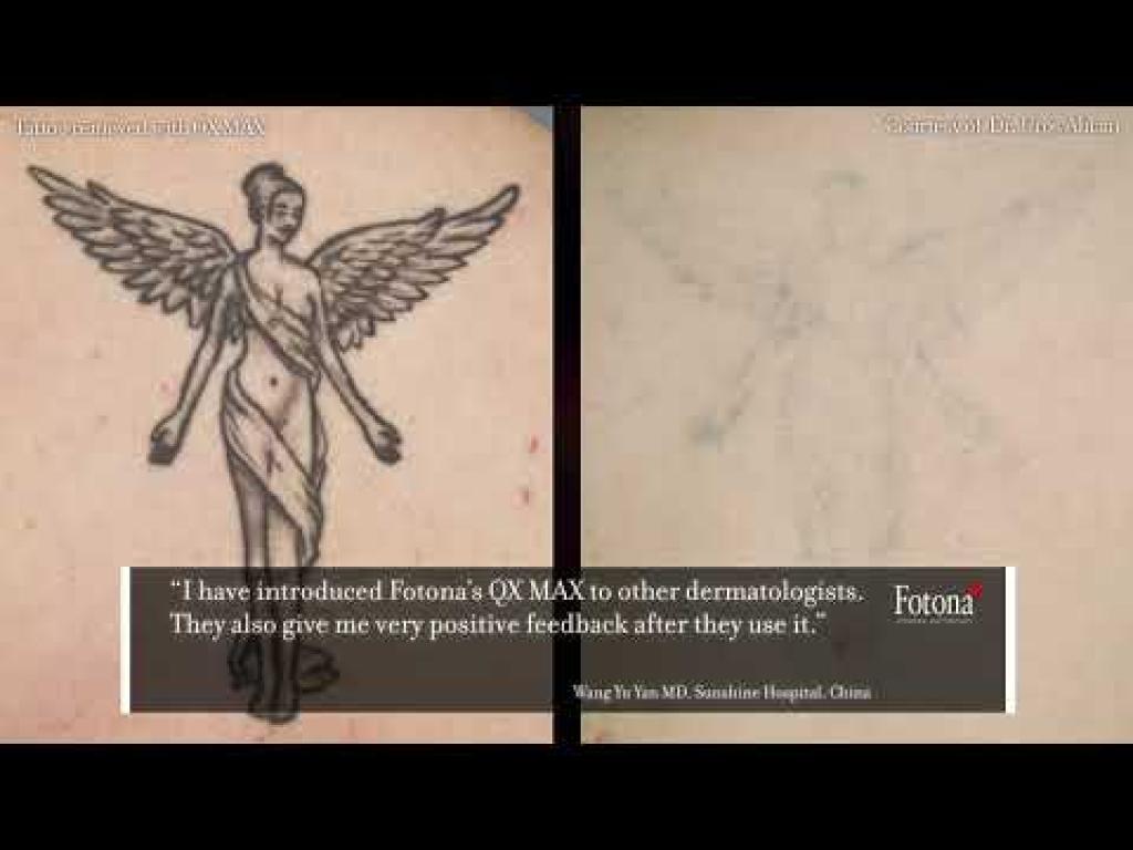 הסרנו הסרנו