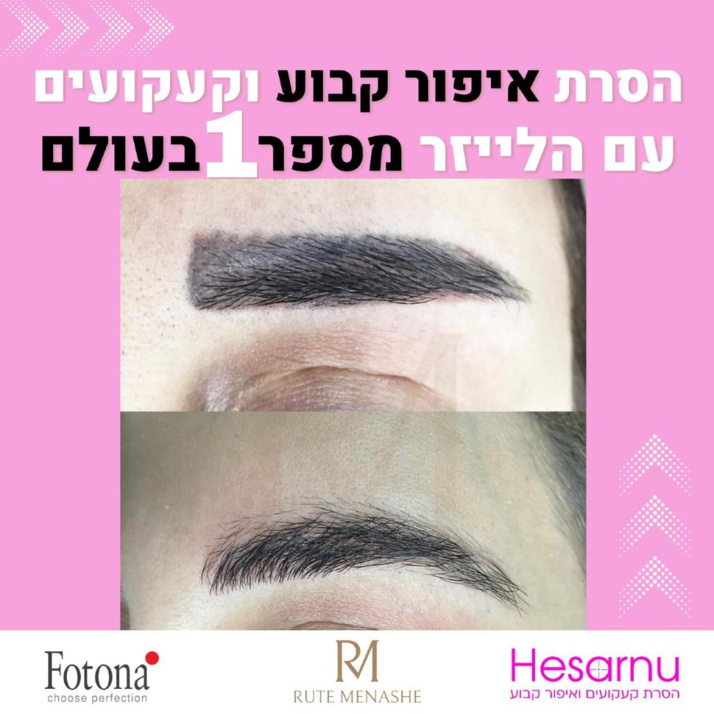 הסרנו הסרנו