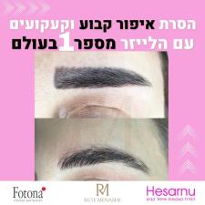 הסרנו