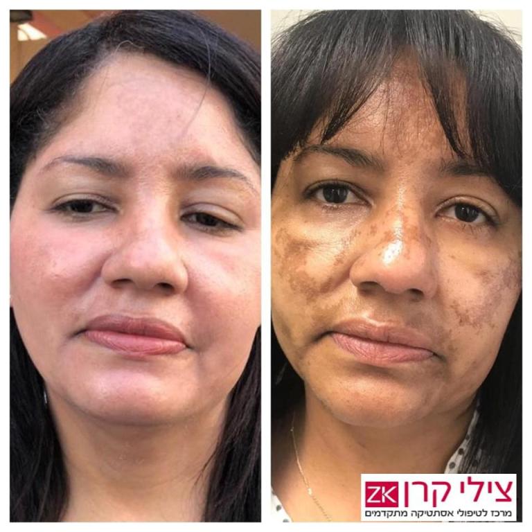 צילי קרן דרמאור קליניק צילי קרן דרמאור קליניק