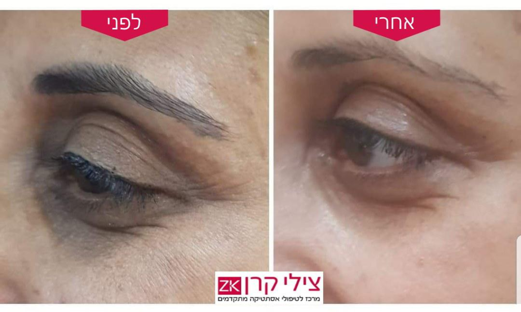 צילי קרן דרמאור קליניק צילי קרן דרמאור קליניק