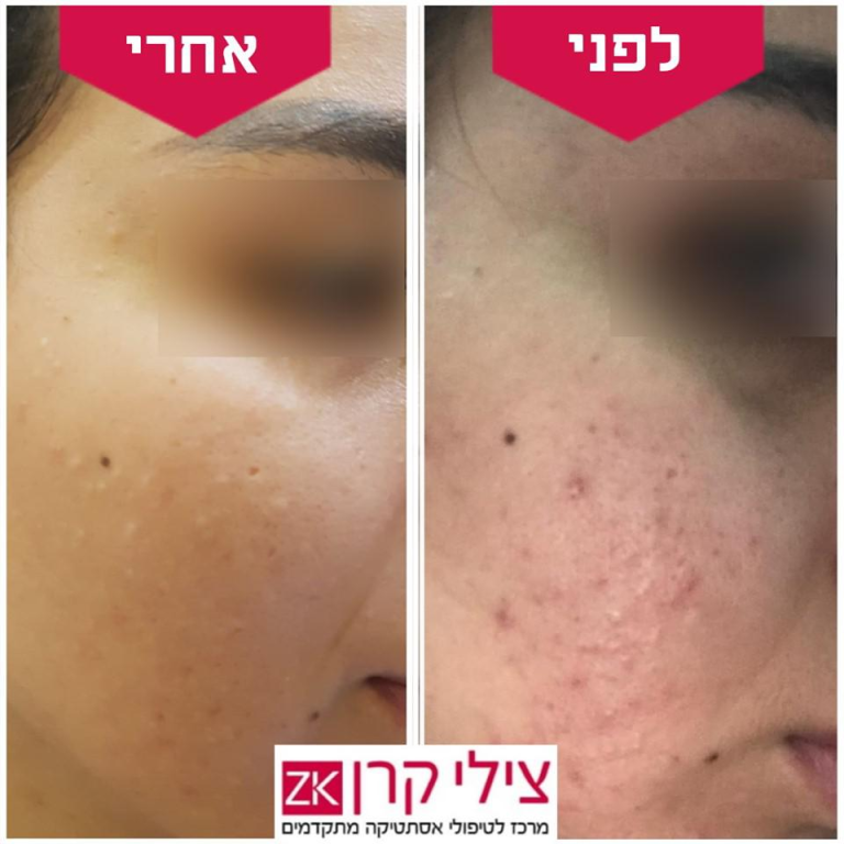 צילי קרן דרמאור קליניק צילי קרן דרמאור קליניק