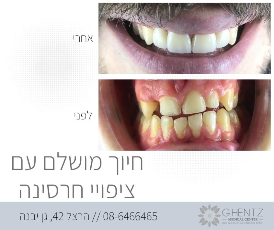 ד"ר חנץ גנדי ד"ר חנץ גנדי