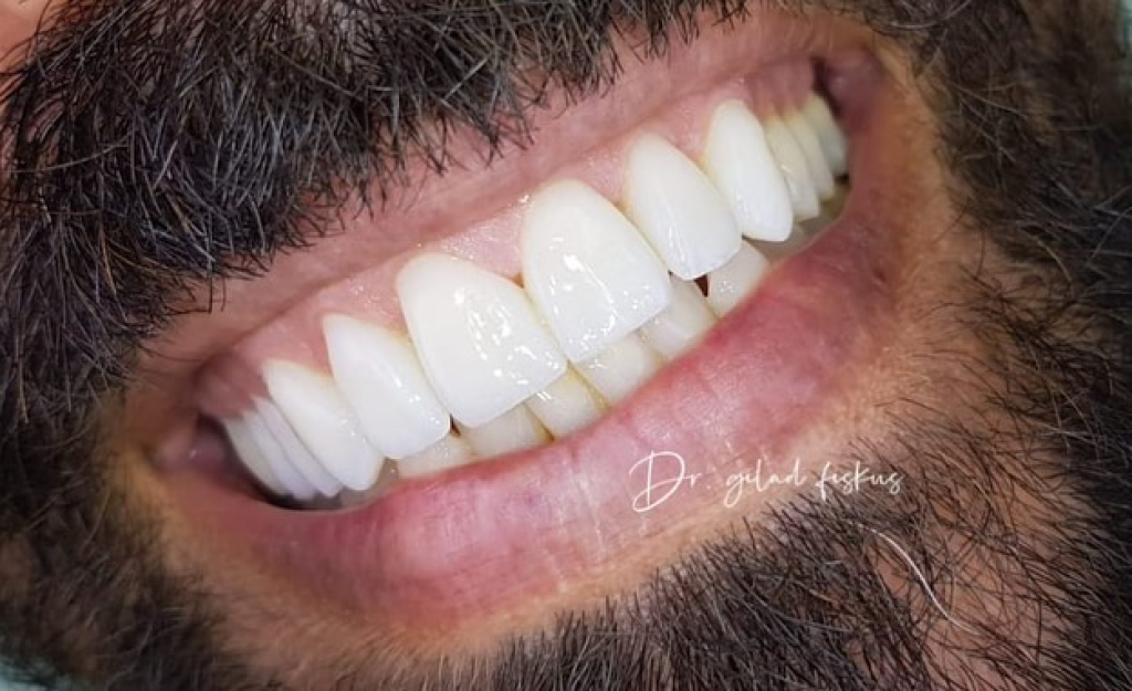ד"ר גלעד פיסקוס אסתטיקה דנטלית ד"ר גלעד פיסקוס אסתטיקה דנטלית