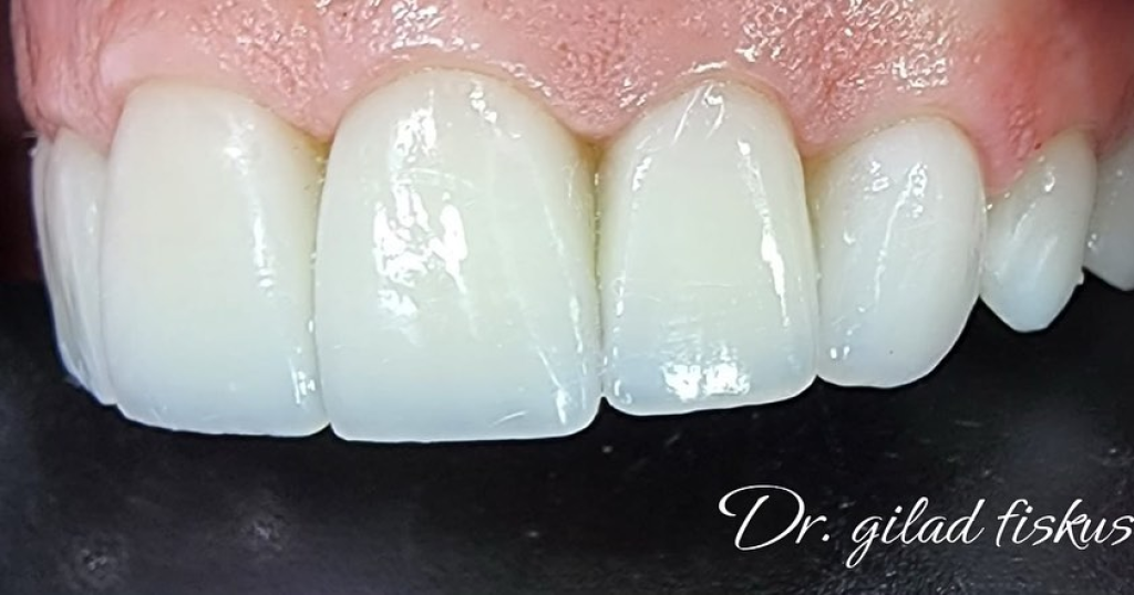 ד"ר גלעד פיסקוס אסתטיקה דנטלית ד"ר גלעד פיסקוס אסתטיקה דנטלית