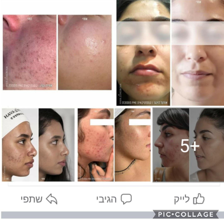 טלי קוסמטיקאית רפואית PME טלי קוסמטיקאית רפואית PME