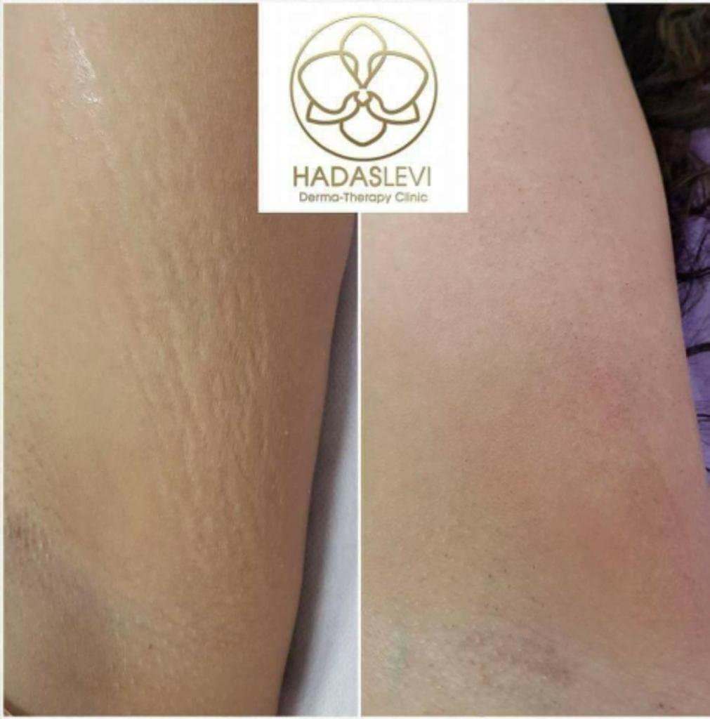 הדס לוי אסתטיקה מתקדמת הדס לוי אסתטיקה מתקדמת