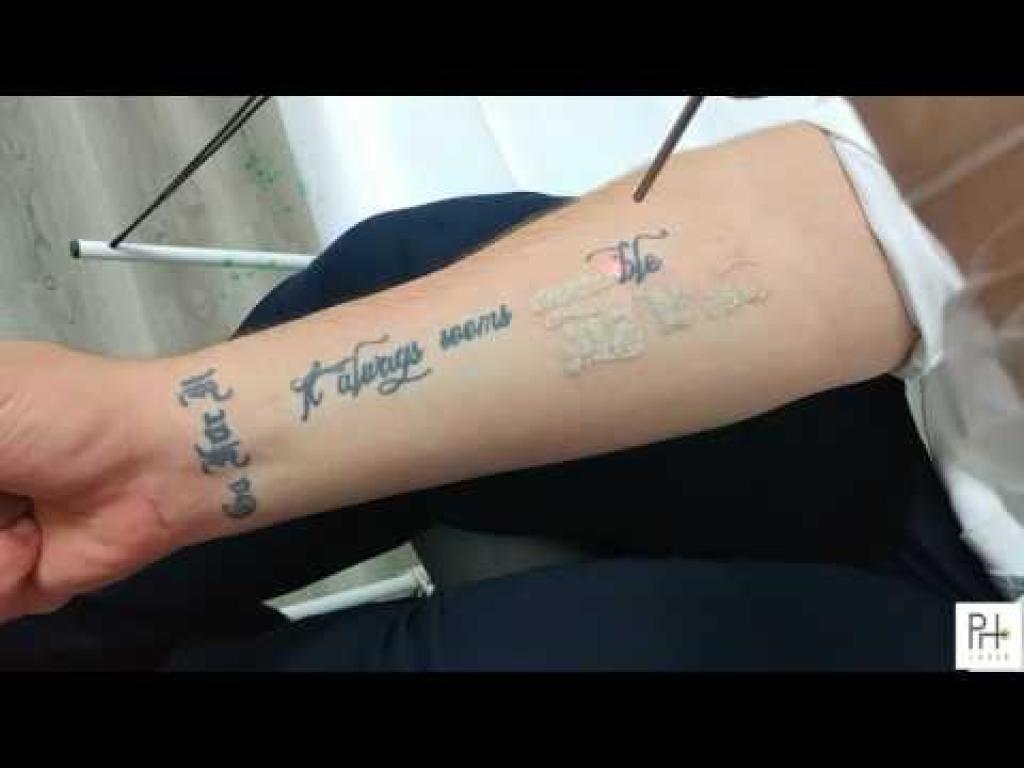 פארמה לייזר פארמה לייזר