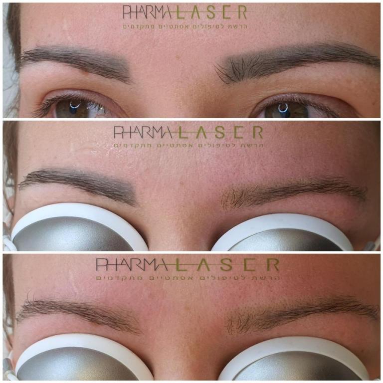 פארמה לייזר פארמה לייזר